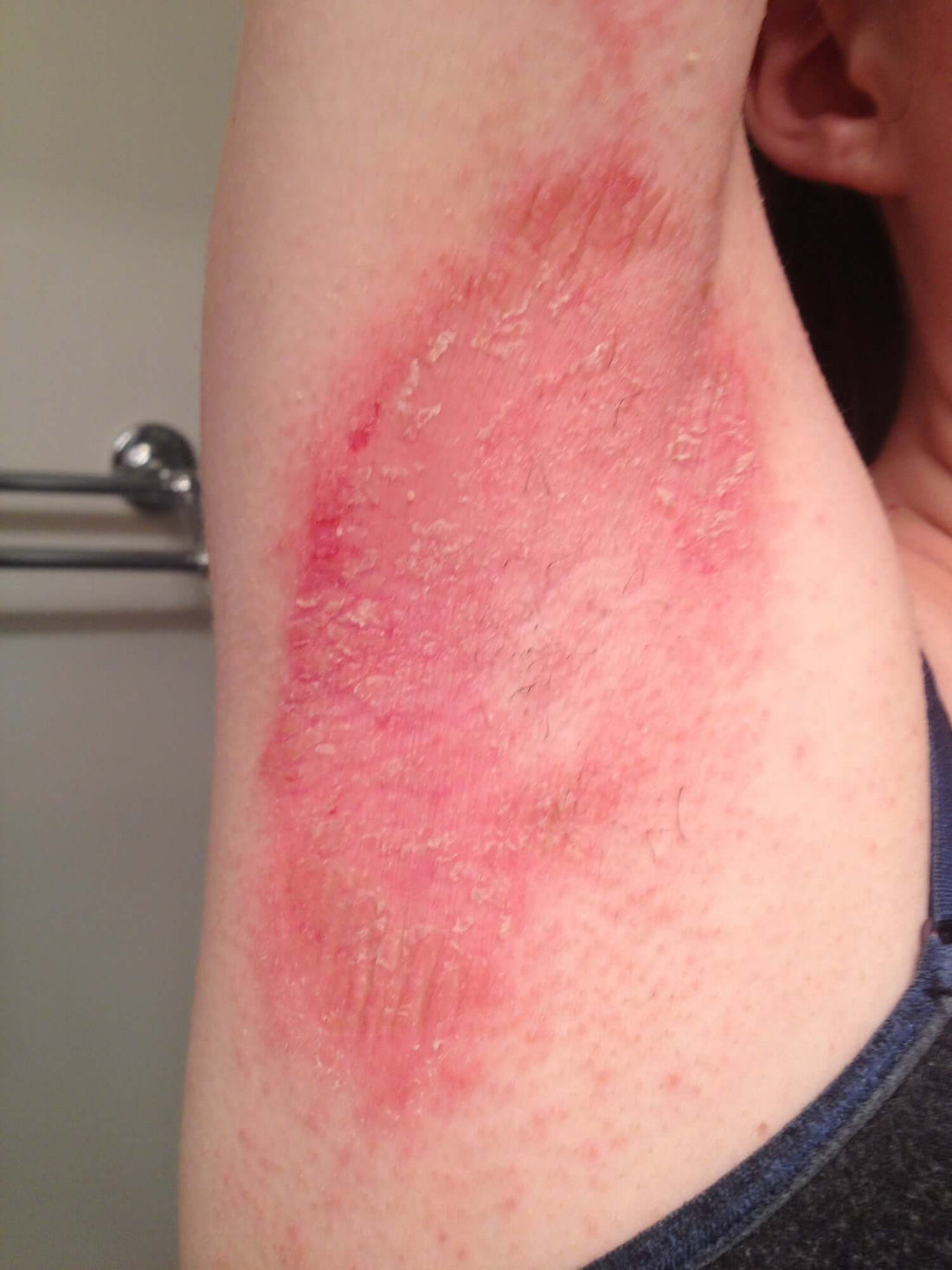 Why Natural Deodorants Cause Rashes: Baking soda pH mismatch guide from Gentle Moose Canada